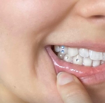 Strass dentaire — photo 1