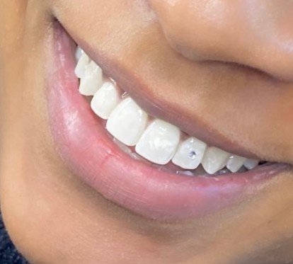 Strass dentaire — miniature 2